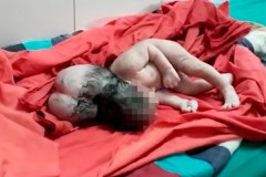 «Трехголовый» младенец из Индии озадачил врачей
